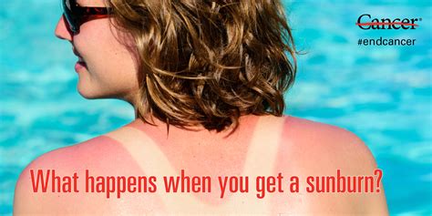 can you get a sunburn after 5pm|Iba pa.